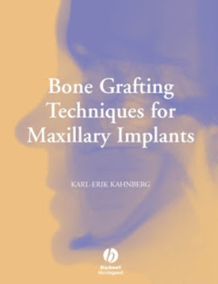 Bone Grafting Techniques for Maxillary Implants PDF Free Download