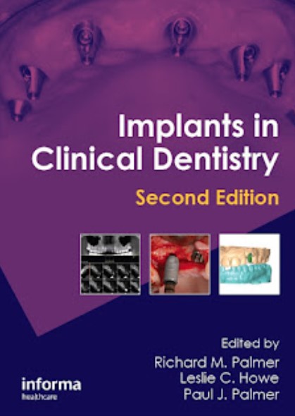 Implants in Clinical Dentistry 2nd Edition PDF Free Download