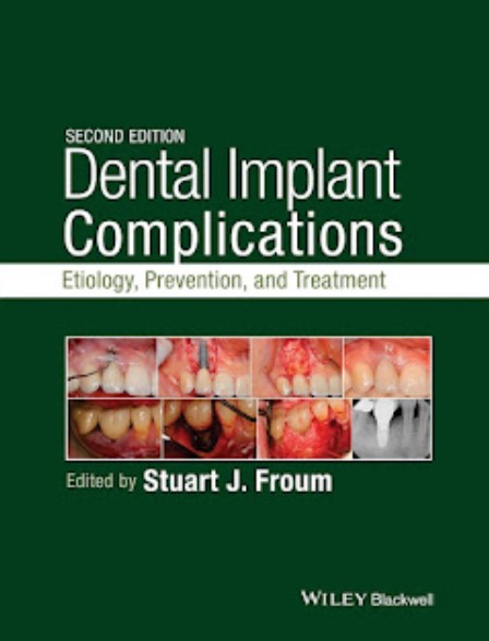 Dental Implant Complications 2nd Edition Etiology, Prevention, and Treatment PDF Free Download