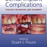 Dental Implant Complications Etiology, Prevention, and Treatment PDF Free Download