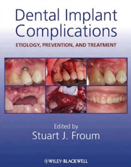 Dental Implant Complications Etiology, Prevention, and Treatment PDF Free Download