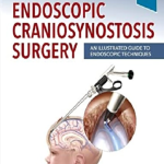 Endoscopic Craniosynostosis Surgery: An Illustrated Guide to Endoscopic Techniques 1st Edition PDF
