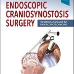 Endoscopic Craniosynostosis Surgery: An Illustrated Guide to Endoscopic Techniques 1st Edition PDF Free